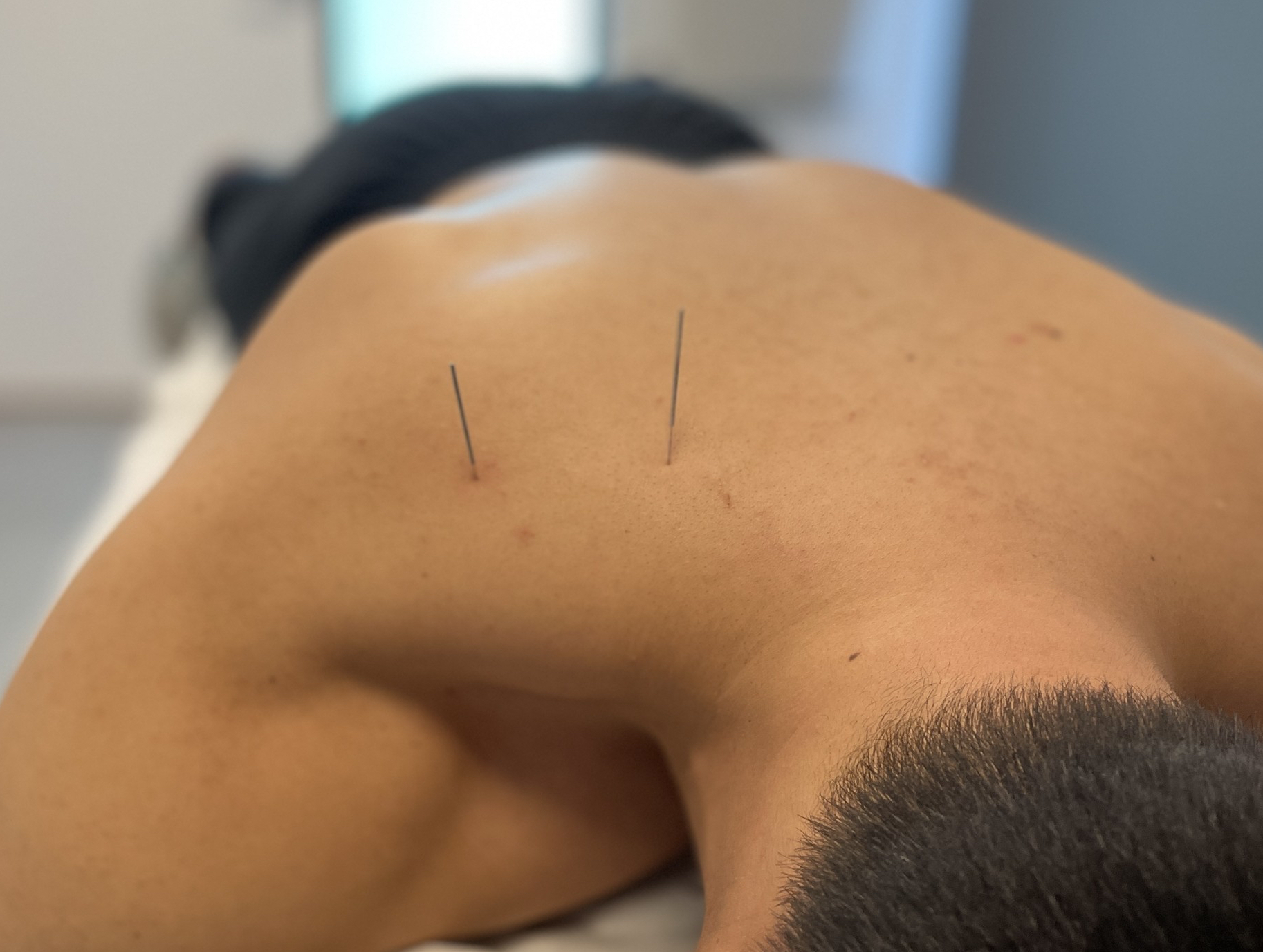 Dry Needling hos Sterk Helse og Trening – effektiv behandling for muskelplager